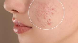 Có nên dùng miếng dán mụn sau khi nặn? 6 lợi ích và cách dùng đúng để tránh thâm sẹo