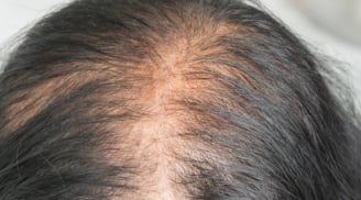 Loại lá chống rụng tóc, kích thích mọc tóc con hiệu quả nhưng đang bị bỏ phí