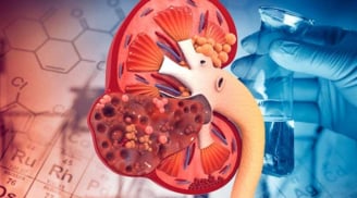 4 dấu hiệu người bị suy thận, buổi tối gặp 1/5 cũng dè chừng