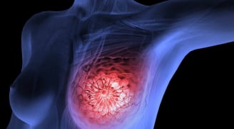 5 dấu hiệu rõ ràng cảnh báo ung thư vú: Đặc biệt dấu hiệu thứ 2 thường xem nhẹ