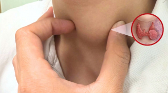 5 nhóm người có nguy cơ cao bị ung thư tuyến giáp