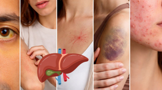 Da xuất hiện 5 dấu hiệu này, đừng chủ quan: Gan có thể đang “kêu cứu”