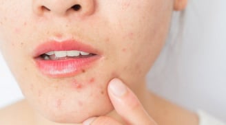 6 sai lầm khiến mụn kéo dài dai dẳng và cách xử lý đúng để da phục hồi hiệu quả
