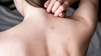 Cải thiện mụn lưng và da sần sùi tại nhà: Routine đơn giản giúp da body mịn màng rõ rệt