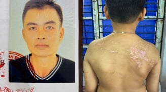 Khởi tố người cha bạo hành con ruột gây thương tích 36% gây phẫn nộ