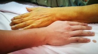 5 dấu hiệu cảnh báo gan thận đang 'kêu cứu', số 1 bệnh đã chuyển nặng