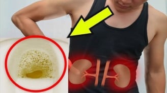 Đi tiểu thấy nhiều bọt có phải bị suy thận?