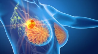“Thủ phạm” gây K tuyến vú nhiều nhất ở phụ nữ