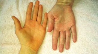 6 dấu hiệu trên cơ thể cảnh báo gan của bạn đang kêu cứu: Nên đi khám gấp