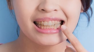 Vì sao răng dễ xỉn màu dù chăm đánh răng? Những nguyên nhân nhiều người thường bỏ qua