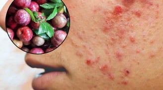 3 đối tượng không được ăn mận: Dễ nổi mụn, nóng trong