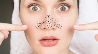 4 sai lầm phổ biến khiến mụn đầu đen ngày càng nhiều dù chăm sóc da đều đặn
