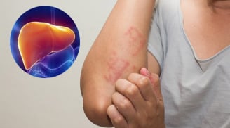 4 dấu hiệu cảnh báo bệnh gan: Có 1/4 cũng nên đi khám sớm