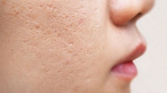 3 lầm tưởng phổ biến về điều trị sẹo mụn khiến nhiều người tốn thời gian mà hiệu quả không như mong đợi