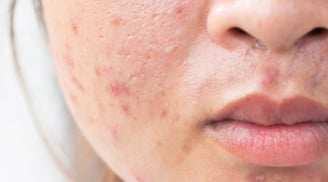 Muốn ngăn mụn tái phát? Đừng bỏ qua 6 bước chăm sóc da giúp duy trì làn da khỏe mạnh
