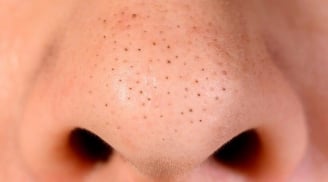 6 thói quen khiến mụn đầu đen dai dẳng hơn, nhiều người vẫn mắc phải mỗi ngày