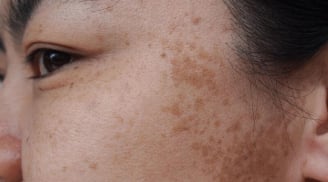 5 thói quen hằng ngày âm thầm khiến làn da dễ bị nám, nhiều người vẫn lặp lại mà không hay biết