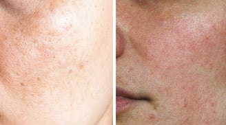 3 nguyên tắc chăm sóc da giúp cải thiện nám sau sinh và lấy lại làn da sáng khỏe