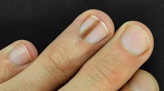 Những dấu hiệu bất thường ở móng tay cảnh báo bệnh nguy hiểm