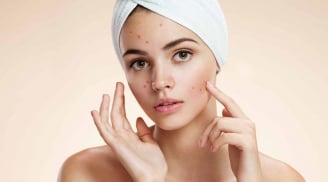Nặn mụn xong đừng vội làm điều này nếu không muốn da thâm lâu và dễ để lại sẹo