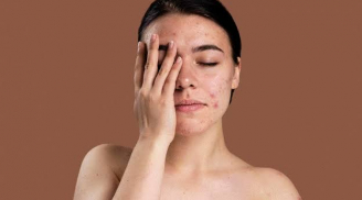 Kem chấm mụn có thực sự hiệu quả? Cách chọn và sử dụng đúng để mụn nhanh phục hồi