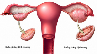Đa nang buồng trứng đổi tên sau 90 năm - Nhiều phụ nữ từng bị hiểu sai