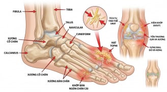 Acid uric tăng cao: 5 biểu hiện dễ bị bỏ qua, nhiều người chỉ phát hiện khi gout đã xuất hiện