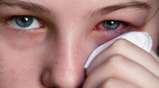 3 dấu hiệu cảnh bào bệnh ung thư mắt