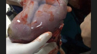Bé gái sinh ra chỉ nặng 800 gram còn nguyên trong bọc ối khiến bác sĩ ngỡ ngàng