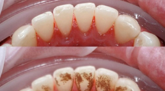 Sạch cao răng vĩnh viễn không cần đi nha sỹ chỉ trong 3 phút