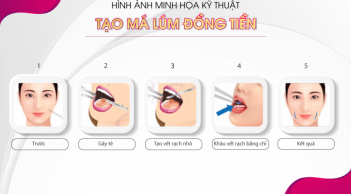 Tạo má lúm đồng tiền - Bí quyết “trang điểm” nét duyên trên gương mặt