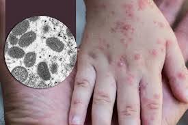 Đậu mùa khỉ là tình trạng khẩn cấp toàn cầu: Chuyên gia chỉ dấu hiệu nhận biết, cách phòng ngừa, ai cũng cần biết