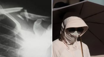 Một phụ nữ bị gãy xương do thói quen che nắng cẩn thận quá mức