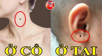 Những nốt ruồi Thần Tài 'đánh dấu', số 3 muốn nghèo cũng khó