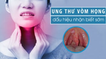 7 dấu hiệu K vòm họng: Số 1 không biết sớm khó mà chữa