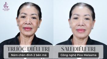 Pico Melasma - Bước tiến công nghệ vượt bậc giúp LG Clinic vươn tầm trong lĩnh vực điều trị nám da