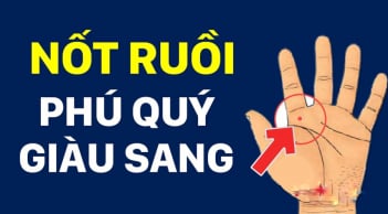 5 nốt ruồi trên tay Ăn May Cả Đời, có 1/5 cũng sướng