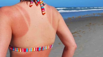 Mẹo đi biển không bị bắt nắng, đen sạm da