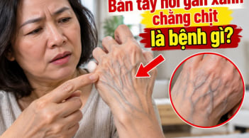 Bàn tay nổi gân xanh chằng chịt là bệnh gì?