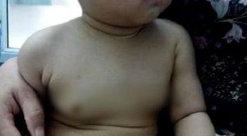 Bé gái 22 tháng tuổi vòng 1 đã như thiếu nữ 18, nguyên nhân do mẹ uống thuốc tránh thai khi cho con bú?