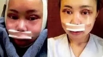 Cô gái Việt đau đớn trải qua 7 ca phẫu thuật để giống Địch Lệ Nhiệt Ba