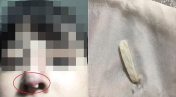 Đi nâng mũi bọc sụn, về nhà cô gái mới ngã ngửa vì thứ đưa vào mũi lại là 'thịt lừa'