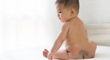 Không muốn con sinh ra bị chàm xanh, chàm đỏ, mẹ bầu cần tránh 2 loại thực phẩm này