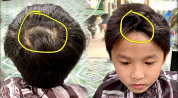 Trẻ nhỏ có 2 xoáy tóc rõ trên đầu sẽ càng thông minh hơn, bác sĩ nói gì?