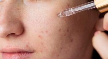 Da mụn dùng retinol như thế nào?