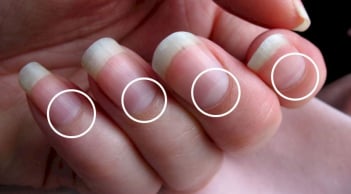 Bắt bệnh qua móng tay của bạn?