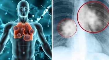 90% ca ung thư phổi ở nam giới Việt: Thói quen này là thủ phạm chính bạn cần biết!