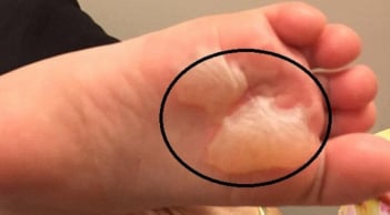 Cách chữa phồng rộp da chân khi đi bộ nhiều, mang giày chật