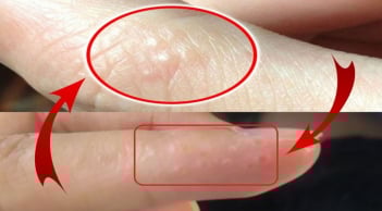 Tay  mọc mụn nước li ti có sao không?