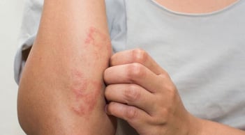 ５dấu hiệu cảnh báo bạn đang mắc bệnh thận giai đoạn nặng: Có 1 cũng nên đi khám sớm